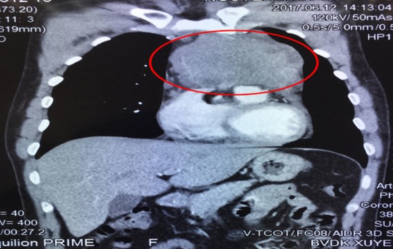 Ảnh chụp CT khối u (khoanh đỏ) trong lồng ngực bệnh nhân trước phẫu thuật 