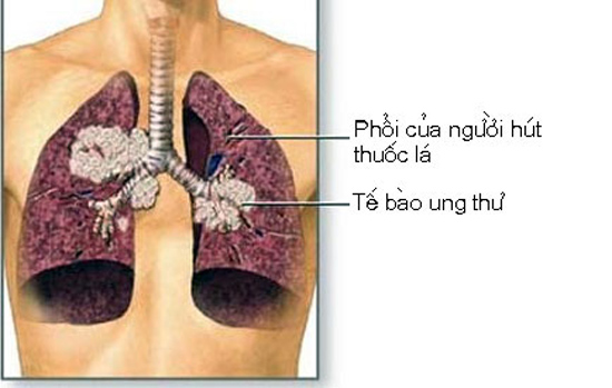 Hút thuốc là một trong những nguyên nhân chính dân đến bệnh ung thư phổi.