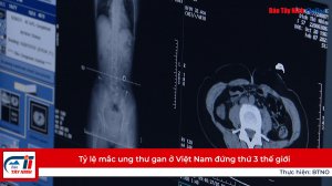 Tỷ lệ mắc ung thư gan ở Việt Nam đứng thứ 3 thế giới