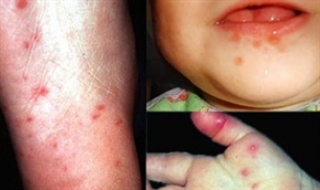 Bộ Y tế chưa công bố dịch tay chân miệng