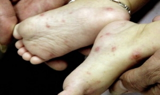 Nước ozone chỉ hỗ trợ chữa bệnh tay chân miệng