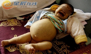 Bé trai hơn 1 tháng tuổi bụng to như trái bóng rổ