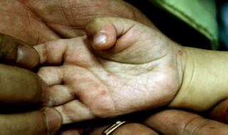 106.500 người mắc tay chân miệng trong năm 2011