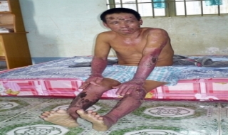 Trả lời bà Phạm Thị Hường: Công ty đã tận tình chăm sóc công nhân bị nạn