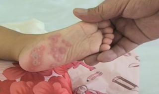 Gần 58.000 trường hợp mắc bệnh tay chân miệng