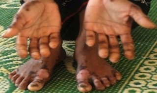 Bệnh lạ tái phát ở Quảng Ngãi