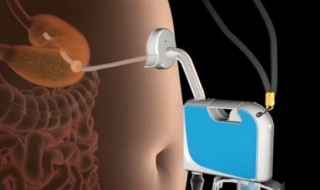 Giảm cân gây sốc bằng cách rút thức ăn khỏi dạ dày