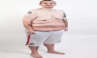 Cuộc sống như địa ngục sau khi giảm 80kg