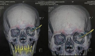 18 năm mới rút dao khỏi hộp sọ