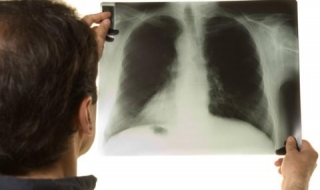 Cảnh báo về nạn trẻ em nhiễm lao không được phát hiện