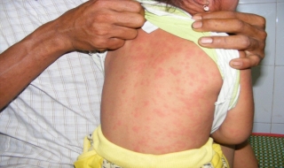 Tây Ninh có 16 ca dương tính với bệnh sởi