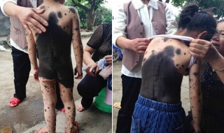 Bé gái bị mẹ bỏ rơi vì mọc lông đen khắp người