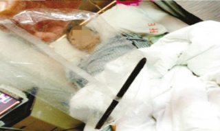 Bút chì dài 17 cm nằm trong bụng suốt 5 năm