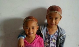 Hai em bé chịu đau, hiến da đầu cứu cha