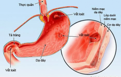 Cảnh báo bệnh dạ dày ở trẻ em đang gia tăng