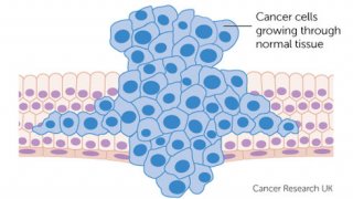 10 cách “né” ung thư