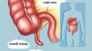 Viêm ruột thừa có thể trị bằng kháng sinh?