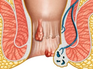 Đắp lá chữa trĩ gây hoại tử hậu môn