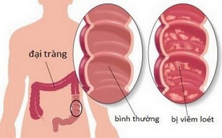 Chọn thuốc trị viêm đại tràng co thắt