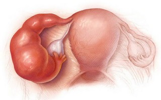 Nội mạc tử cung là lớp màng mỏng lót mặt trong tử cung