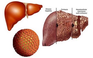 Viêm gan B là sát thủ thầm lặng