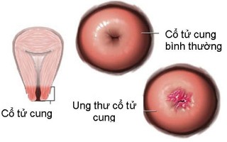 Pap là xét nghiệm giúp phát hiện ung thư cổ tử cung