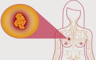 Cách tự khám ngực để phát hiện sớm ung thư vú