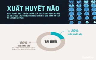 Xuất huyết não khởi điểm từ đâu?