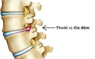 Thoái hóa cột sống sau 40 năm nằm võng