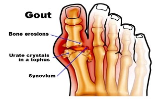 Gout là một bệnh rối loạn chuyển hoá các nhân purin