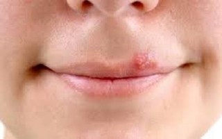 Herpes môi là do virus herpes simplex gây nên
