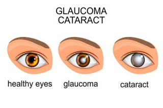 Hãy khám sàng lọc Glaucoma sớm để bảo vệ đôi mắt