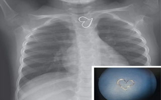 'Trái tim vàng' trên ảnh X-quang của bé gái