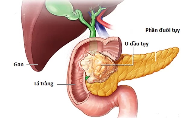 Dấu hiệu sớm ung thư tuỵ