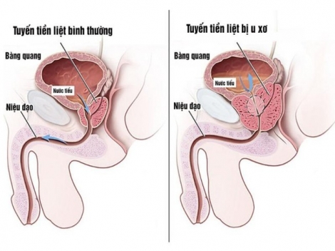 Dấu hiệu u xơ tuyến tiền liệt