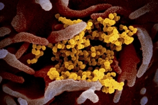 Bệnh nhân HIV nhiễm nCoV ít tử vong