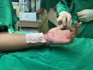 Phẫu thuật nối liền bàn tay cho một nam bệnh nhân bị chém đứt lìa