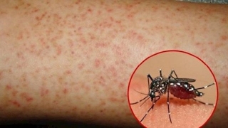 Các biến chứng nguy hiểm do sốt xuất huyết