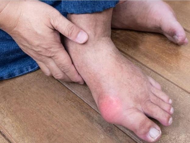 Lợi ích của tập luyện với người bệnh gout, thực hành thế nào?