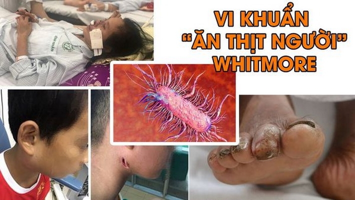 Bệnh Whitmore là gì, cách điều trị và dự phòng để tránh tử vong