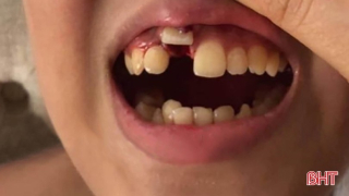 Răng rơi khỏi huyệt ổ răng, xử trí thế nào?