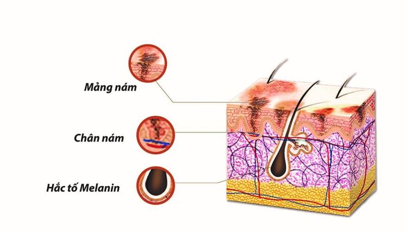 Công nghệ trị nám, tàn nhang trong bộ Spotlite