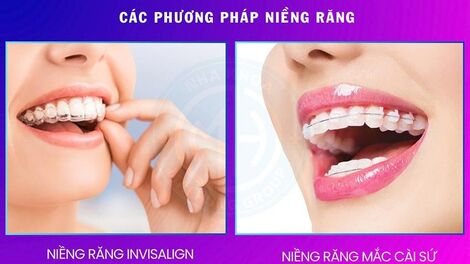 Đã bọc răng sứ có niềng răng được không?