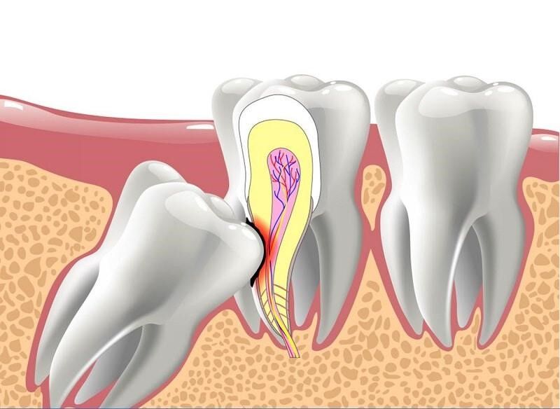 Răng khôn mọc lệch có làm ảnh hưởng đến sức khoẻ không?