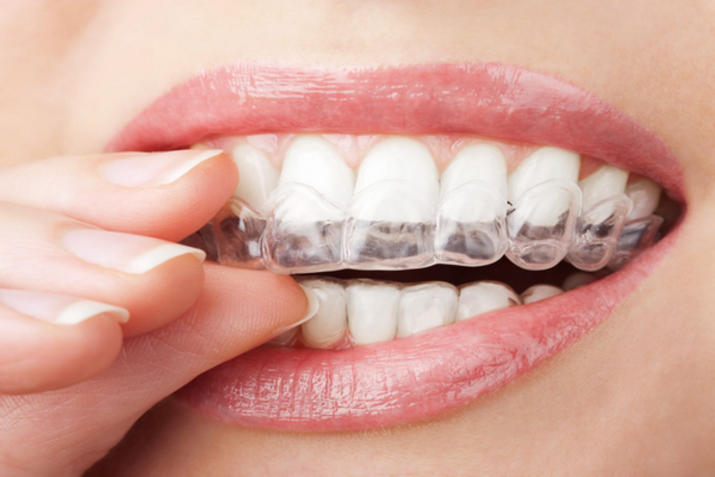 Niềng răng Invisalign bằng công nghệ iTero 5D nha khoa quốc tế Phú Hòa