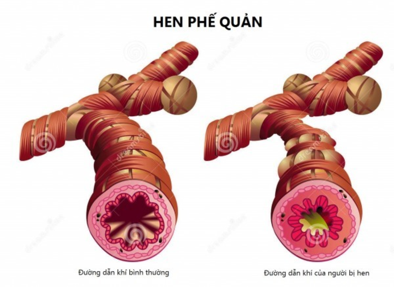 Dấu hiệu cảnh báo cơn hen phế quản cấp tính và cơn hen nguy kịch