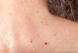 Top 6 sai lầm khiến mụn thịt mọc nhiều hơn mà ai cũng mắc phải