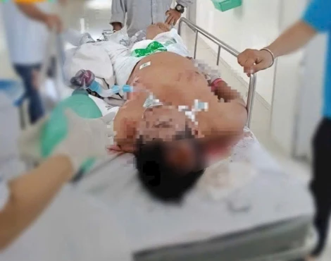 Người đàn ông bị điện giật nguy kịch, gia cảnh khó khăn